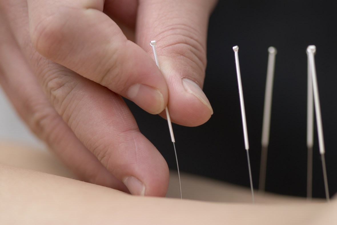 acupuncture (1)
